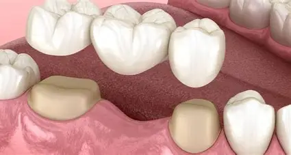 Crowns, Bridges & Removable Prosthetic Treatments