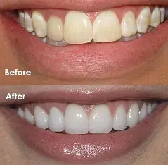 Veneers and Porcelain Laminates