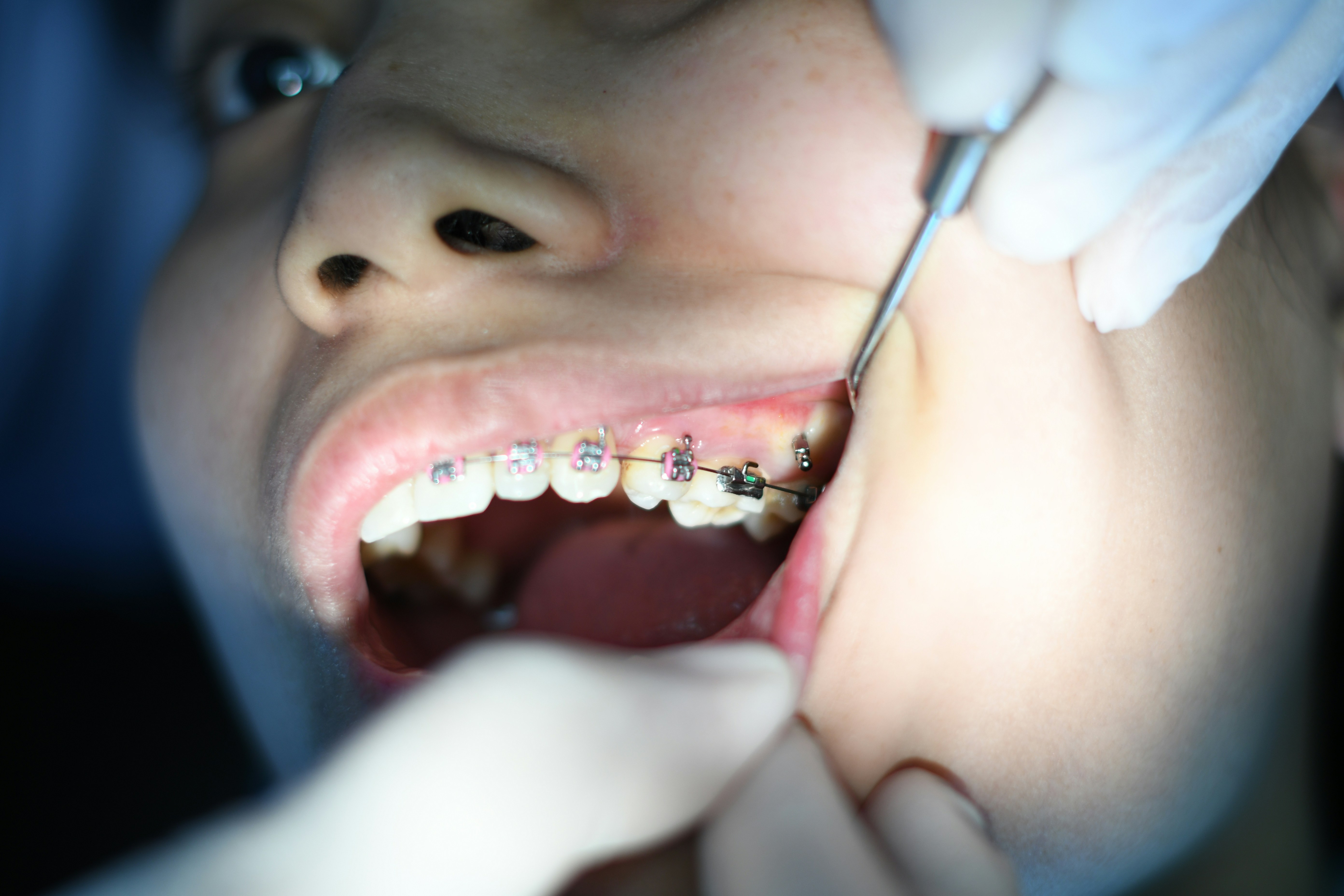 Fixed Orthodontic Treatments