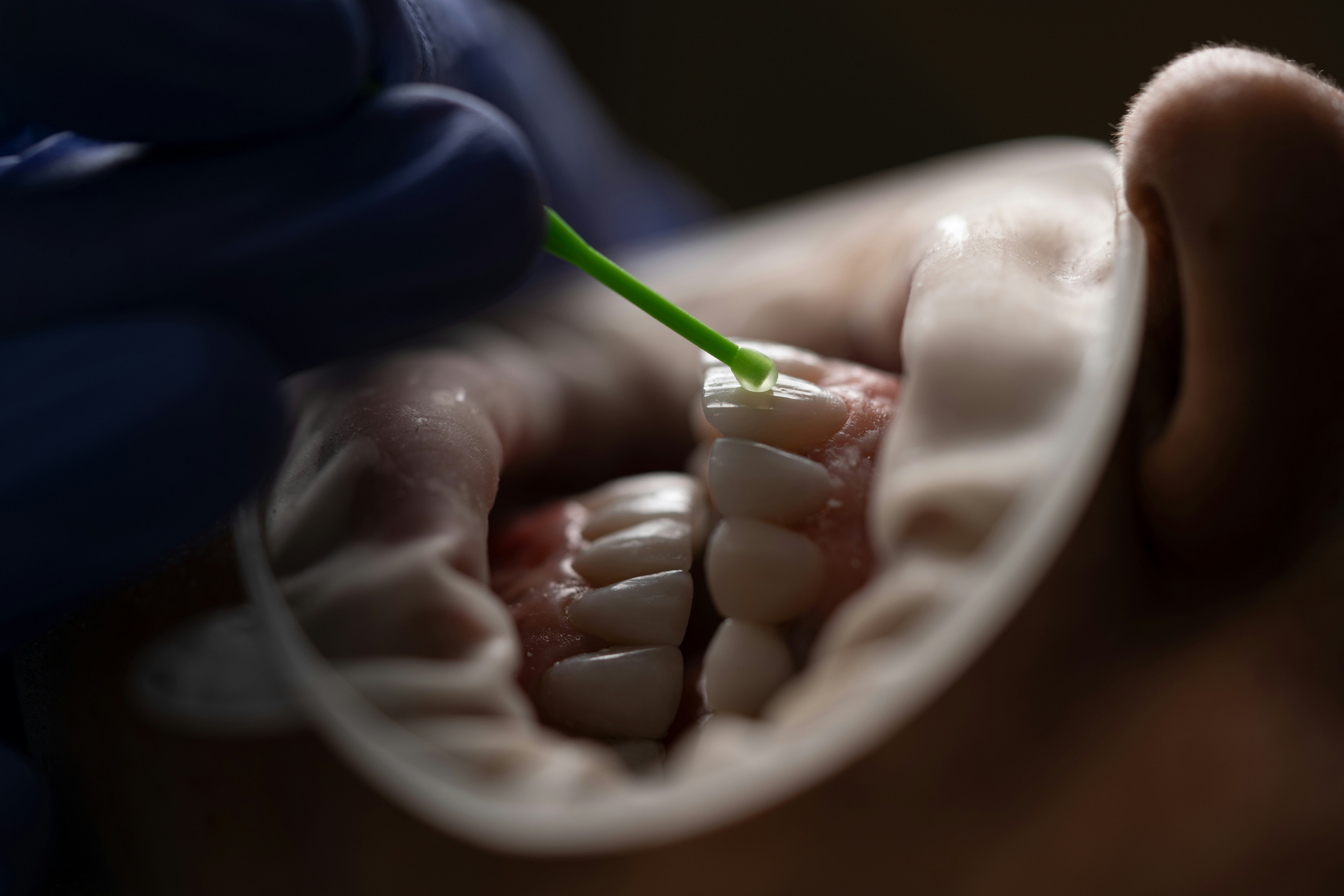 Painless Root Canal Treatment Using Advanced Techniques