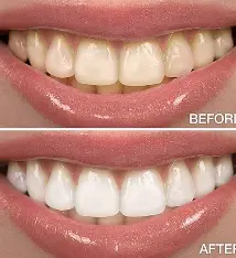 Teeth Whitening
